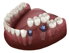 Dental Implants